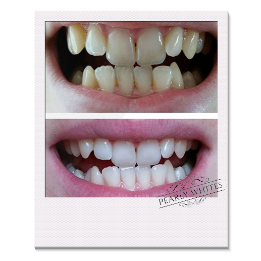 Teeth Whitening before and after photos from a Pearly Whites customer