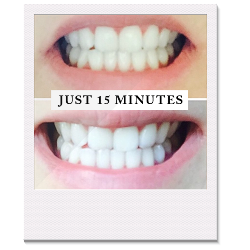 Pearly Whites Teeth Whitening kit before and after photo