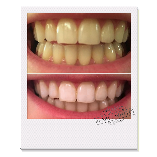 Pearly Whites Pro Kit before and after photo