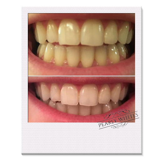 before and after photo from a Pearly Whites customer 